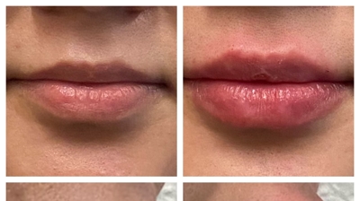 Revanesse Versa Plus Dermal Filler Lips Injection Photo